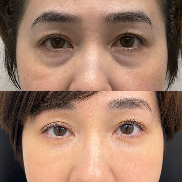 裏ハムラ＋ナノリッチ脂肪注入 ビフォーアフターイメージ