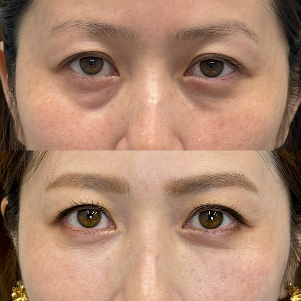 クマ治療 ビフォーアフターイメージ