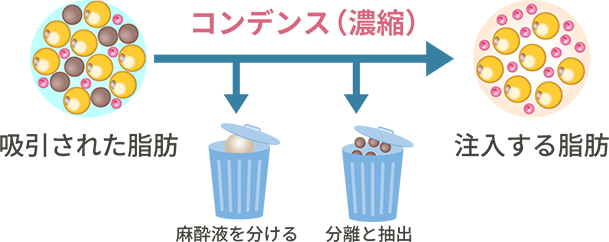 コンデンスリッチ脂肪注入イメージ