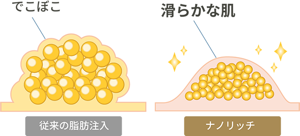 ナノリッチ脂肪注入イメージ