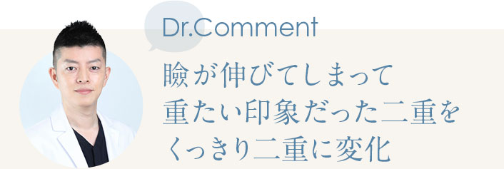 Dr.Comment 瞼が伸びてしまって重たい印象だった二重をくっきり二重に変化