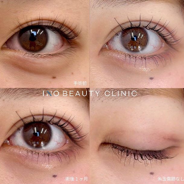 INOシークレットループ イメージ