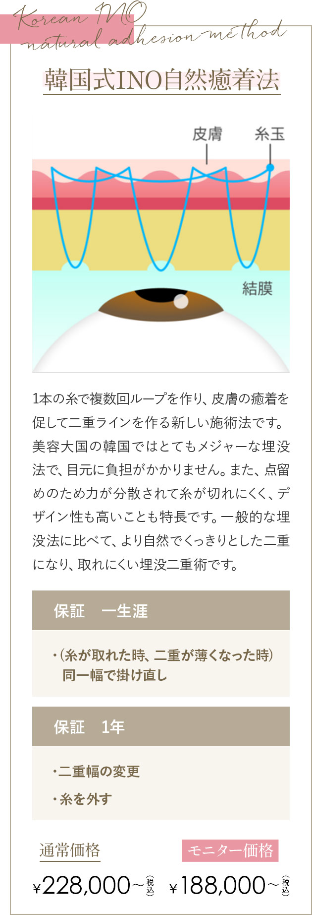 韓国式INO自然癒着法 1本の糸で複数回ループを作り、皮膚の癒着を促して二重ラインを作る新しい施術法です。美容大国の韓国ではとてもメジャーな埋没法で、目元に負担がかかりません。また、点留めのため力が分散されて糸が切れにくく、デザイン性も高いことも特長です。一般的な埋没法に比べて、より自然でくっきりとした二重になり、取れにくい埋没二重術です。